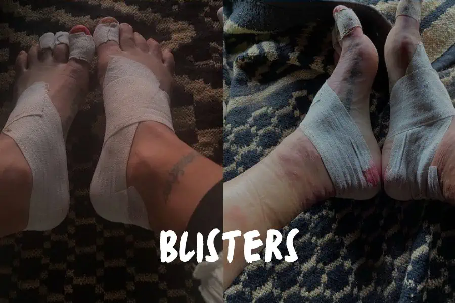 blisters